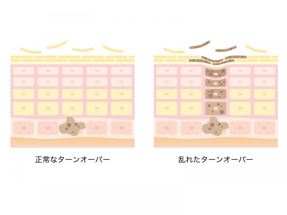 肌のターンオーバー
