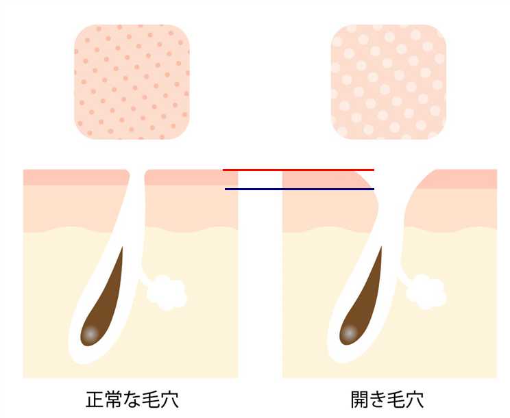 開いた毛穴