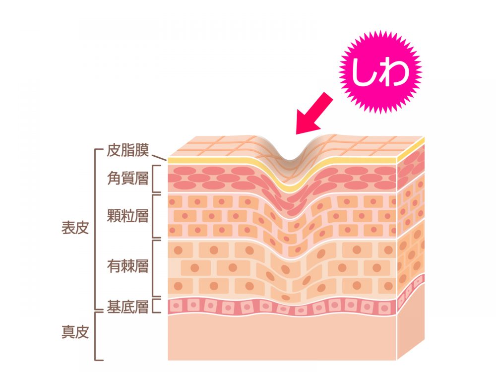 表皮シワ